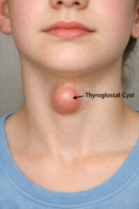 Singapore patient with thyroglossal cyst on neck