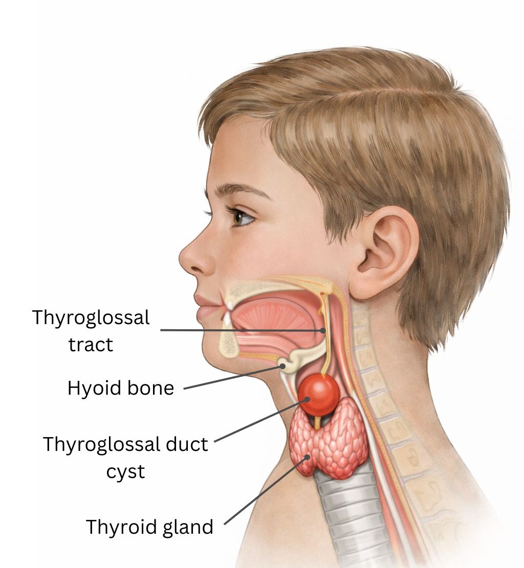 medical illustration of a thyroglossal cyst