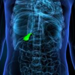 Gallbladder Adenomyomatosis