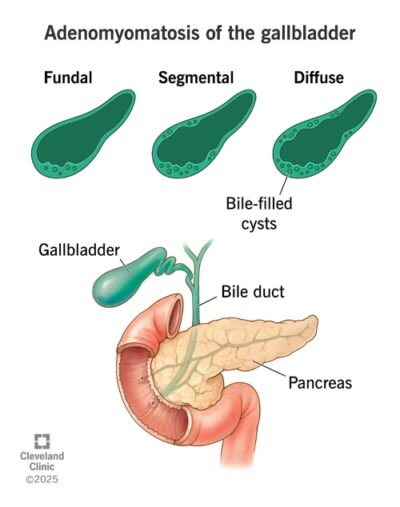 Illustration of Gallbladder Adenomyomatosis Types