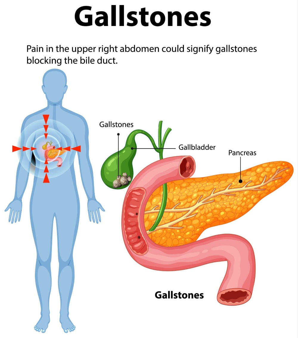 	Gallstones illustration showing stones in the gallbladder and pain in the upper right abdomen