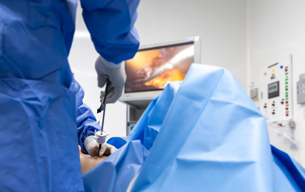 Surgeon performing laparoscopic gallbladder removal with a camera monitor in the operating theatre